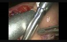Laparoscopic Duodenopancreatectomy with Robotic Biliodigestive Anastomosis