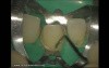 Ceramic Veneers Adhesive Cementation (3/4)
