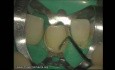 Ceramic Veneers Adhesive Cementation (3/4)