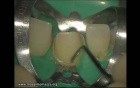 Ceramic Veneers Adhesive Cementation (3/4)