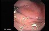 Colonoscopic Polypectomy (12 of 23)