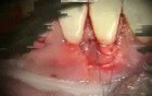 Periodontal Microsurgery: Grafting with Human Donor Dermis