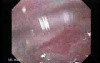 Duodenal Ulcer (4 of 4)