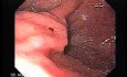 Gastric Varices - Endoscopic Ablation With Cyanoacrylate Glue (17 of 18)