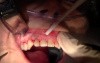 Flap Reflection And Atraumatic Extraction - Extraction #7 With Socket Grafting