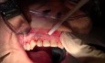 Flap Reflection And Atraumatic Extraction - Extraction #7 With Socket Grafting