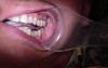 Bridge Insert: Porcelain Contour Adjustment