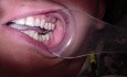 Bridge Insert: Porcelain Contour Adjustment