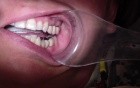 Bridge Insert: Porcelain Contour Adjustment