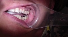 Bridge Insert: Porcelain Contour Adjustment