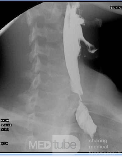 Colonic interposition for Esophageal Substitution (14 of 14)