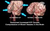 Abnormally Increased ICP in the Fetal Brain