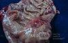 Diffuse Adenocarcinoma with signet ring cells (5 of 18)