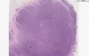 Burkitt lymphoma - Histopathology - Colon