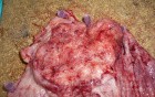 Adenocarcinoma of the cardias and gastric fundus with signet-ring cells (9 of 25)