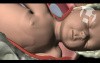 Shoulder Dystocia