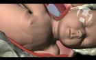 Shoulder Dystocia