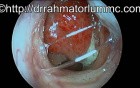 Inflamed Nasopharyngeal Lymphoid Tissue