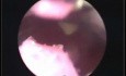 Hysteroscopy of artificial uterus
