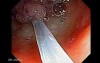 Giant Tubulo - Villous Adenoma (9 of 17)