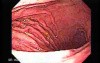 Acute Gastritis (4 of 6)