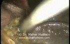 Laparoscopic Conversion of Gastric Band 