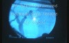 Laparoscopic Cholecystectomy