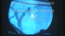 Laparoscopic Cholecystectomy