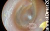 Retracted Eardrum