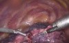 Thoracoscopic lung surgery