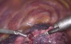 Thoracoscopic lung surgery