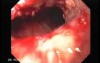 Synchronous Cancer (Gastric and Esophageal) - Endoscopic Image of Esophageal Carcinoma of the Middle Third