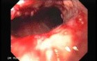 Synchronous Cancer (Gastric and Esophageal) - Endoscopic Image of Esophageal Carcinoma of the Middle Third