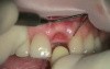 From Extraxtion To Implantation