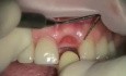 From Extraxtion To Implantation