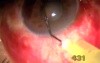 Neovascular Glaucoma - Singh Filtration
