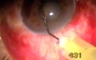 Neovascular Glaucoma - Singh Filtration