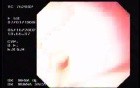 Enormous Tubulovillous tumor (2 of 2)