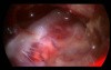 Petroclival Endoscopic Inspection