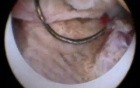 Hysteroscopic Removal of Endometrium