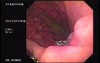 Intraluminal Endoscopic Suturing - A Follow Up After 6 Months