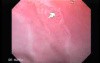 Endoscopic view of Barrett Esophagus (1 of 9)