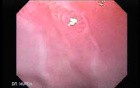Endoscopic view of Barrett Esophagus (1 of 9)