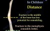 Bone healing and remodeling in children - Video Lecture