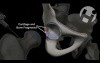 Open Reduction and Internal Fixation of the Hip