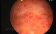 Chronique Endometritis