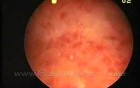 Chronique Endometritis