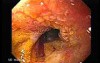Chromatoscopy Of Barrett's Esophagus