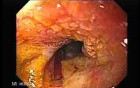 Chromatoscopy Of Barrett's Esophagus