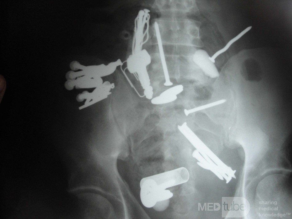 Multiple Foreign bodies in the GI tract (8 of 12)
